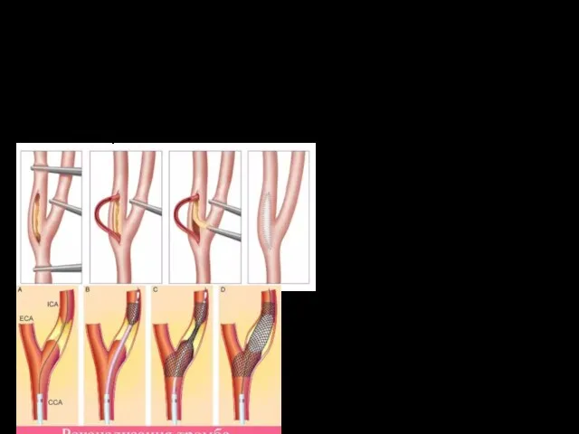 Показания и методики операций при острых тромбозах и эмболиях ВИДЕО.