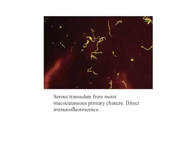 Serous transudate from moist mucocutaneous primary chancre. Direct immunofluorescence.