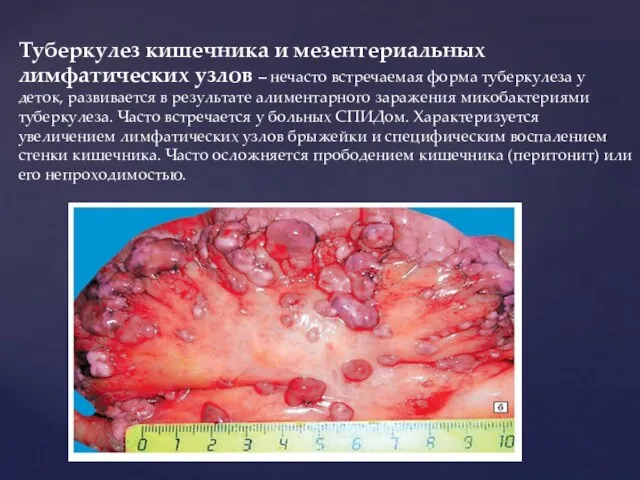 Туберкулез кишечника и мезентериальных лимфатических узлов – нечасто встречаемая форма