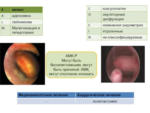 АМК-Р Могут быть бессимптомными, могут быть причиной АМК, могут спонтанно исчезать