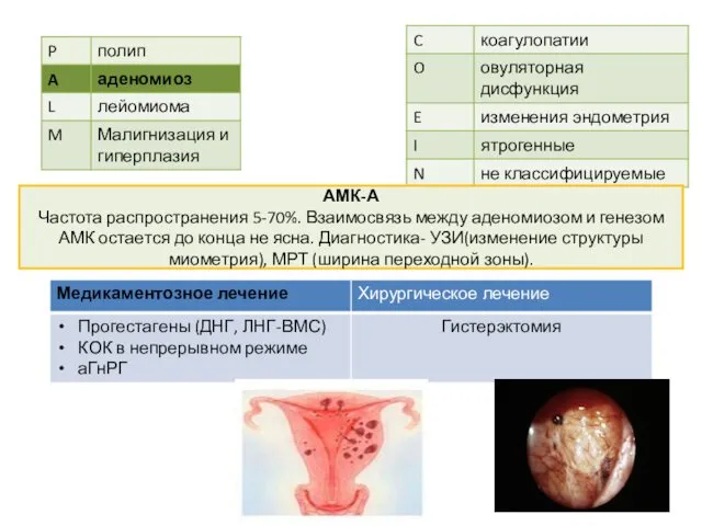 АМК-А Частота распространения 5-70%. Взаимосвязь между аденомиозом и генезом АМК