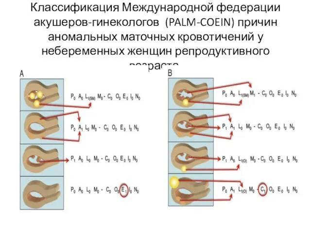 Классификация Международной федерации акушеров-гинекологов (PALM-COEIN) причин аномальных маточных кровотичений у небеременных женщин репродуктивного возраста.