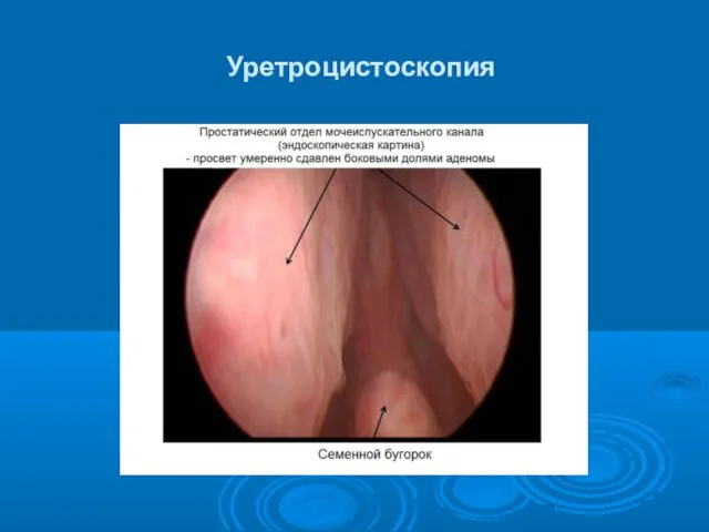 Уретроцистоскопия