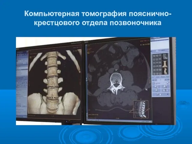 Компьютерная томография пояснично-крестцового отдела позвоночника