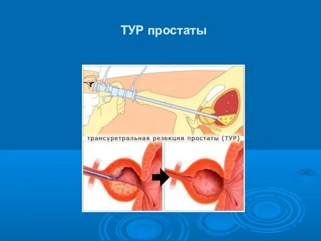 ТУР простаты