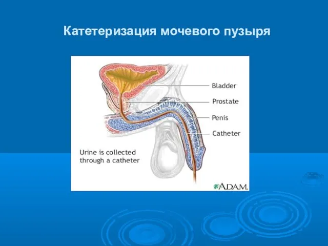 Катетеризация мочевого пузыря