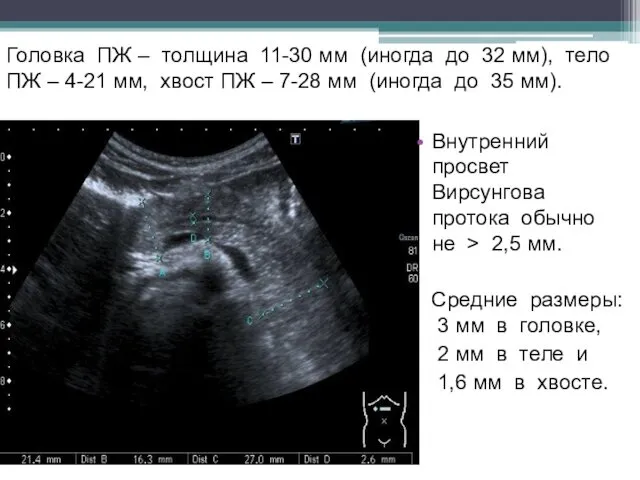 Головка ПЖ – толщина 11-30 мм (иногда до 32 мм),