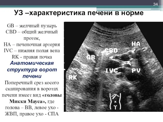 GB – желчный пузырь CBD – общий желчный проток, НА