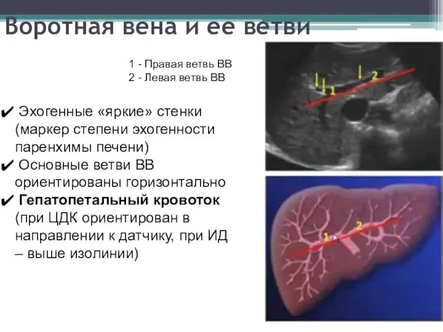 Воротная вена и ее ветви 1 - Правая ветвь ВВ