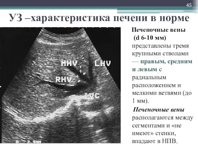 УЗ –характеристика печени в норме Печеночные вены (d 6-10 мм)