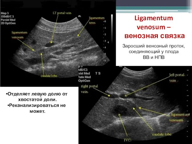 Ligamentum venosum – венозная связка Заросший венозный проток, соединяющий у