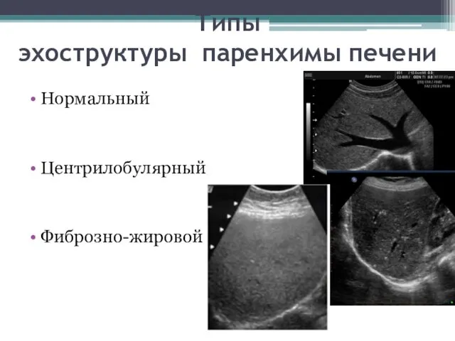 Типы эхоструктуры паренхимы печени Нормальный Центрилобулярный Фиброзно-жировой