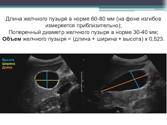 Длина желчного пузыря в норме 60-80 мм (на фоне изгибов
