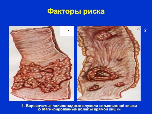 Факторы риска 1- Ворсинчатые полиповидные опухоли сигмовидной кишки 2- Магнизированные полипы прямой кишки 1 2
