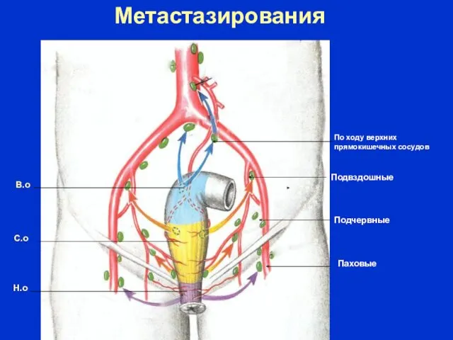 В.о С.о Н.о Метастазирования По ходу верхних прямокишечных сосудов Паховые Подчервные Подвздошные