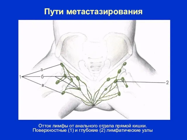 Пути метастазирования Отток лимфы от анального отдела прямой кишки. Поверхностные (1) и глубокие (2) лимфатические узлы