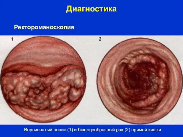 Диагностика Ворсинчатый полип (1) и блюдцеобразный рак (2) прямой кишки 1 2 Ректороманоскопия