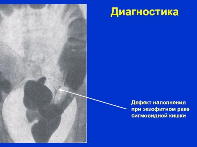 Диагностика Дефект наполнения при экзофитном раке сигмовидной кишки