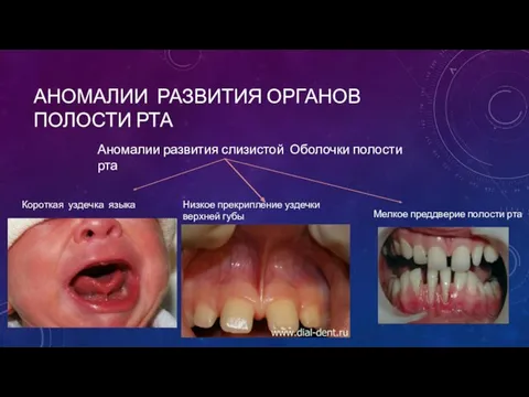 АНОМАЛИИ РАЗВИТИЯ ОРГАНОВ ПОЛОСТИ РТА Аномалии развития слизистой Оболочки полости