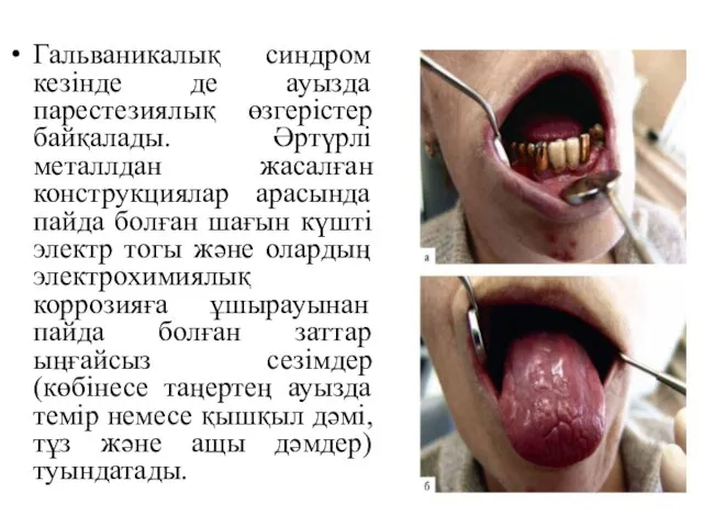 Гальваникалық синдром кезінде де ауызда парестезиялық өзгерістер байқалады. Әртүрлі металлдан