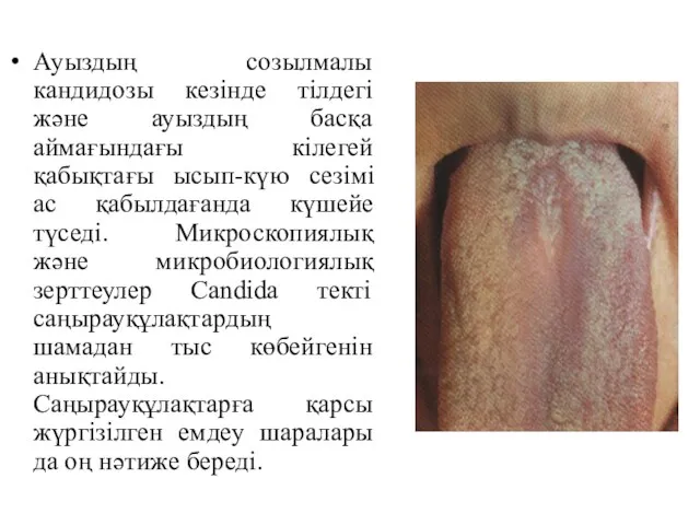 Ауыздың созылмалы кандидозы кезінде тілдегі және ауыздың басқа аймағындағы кілегей