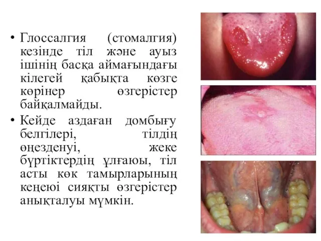 Глоссалгия (стомалгия) кезінде тіл және ауыз ішінің басқа аймағындағы кілегей