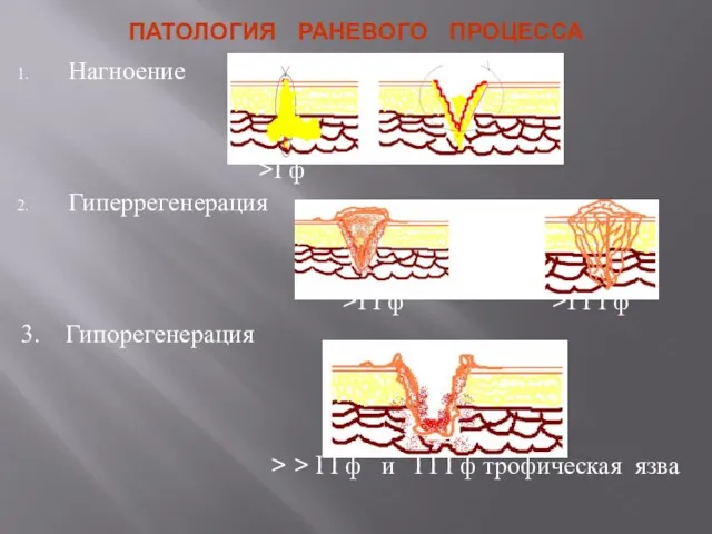 ПАТОЛОГИЯ РАНЕВОГО ПРОЦЕССА Нагноение >I ф Гиперрегенерация >I I ф