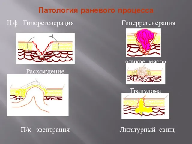 Патология раневого процесса II ф Гипорегенерация Расхождение П/к эвентрация Гиперрегенерация «дикое мясо» Гранулома Лигатурный свищ