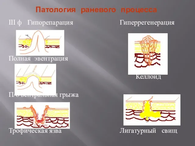 Патология раневого процесса III ф Гипорепарация Полная эвентрация П/о вентральная