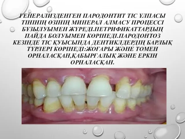 ГЕНЕРАЛИЗДЕНГЕН ПАРОДОНТИТ ТІС ҰЛПАСЫ ТІНІНІҢ ӨЗІНІҢ МИНЕРАЛ АЛМАСУ ПРОЦЕССІ БҰЗЫЛУЫМЕН ЖҮРЕДІ.ПЕТРИФИКАТТАРДЫҢ ПАЙДА БОЛУЫМЕН