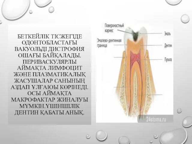 БЕТКЕЙЛІК ТІСЖЕГІДЕ ОДОНТОБЛАСТАҒЫ ВАКУОЛЬДІ ДИСТРОФИЯ ОШАҒЫ БАЙҚАЛАДЫ.ПЕРИВАСКУЛЯРЛЫ АЙМАҚТА ЛИМФОЦИТ ЖӘНЕ ПЛАЗМАТИКАЛЫҚ ЖАСУШАЛАР САНЫНЫҢ