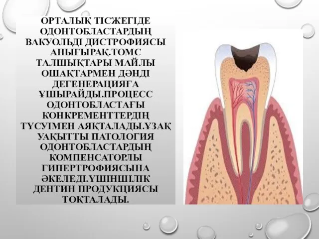 ОРТАЛЫҚ ТІСЖЕГІДЕ ОДОНТОБЛАСТАРДЫҢ ВАКУОЛЬДІ ДИСТРОФИЯСЫ АНЫҒЫРАҚ.ТОМС ТАЛШЫҚТАРЫ МАЙЛЫ ОШАҚТАРМЕН ДӘНДІ ДЕГЕНЕРАЦИЯҒА ҰШЫРАЙДЫ.ПРОЦЕСС ОДОНТОБЛАСТАҒЫ