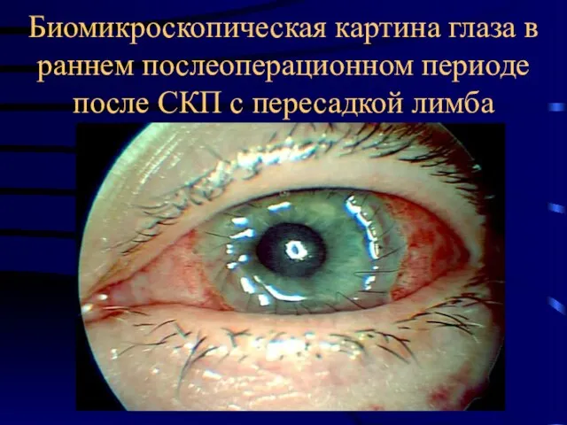 Биомикроскопическая картина глаза в раннем послеоперационном периоде после СКП с пересадкой лимба