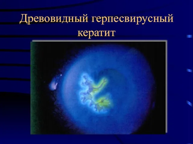 Древовидный герпесвирусный кератит