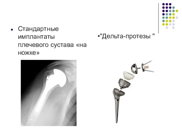 Стандартные имплантаты плечевого сустава «на ножке» "Дельта-протезы "