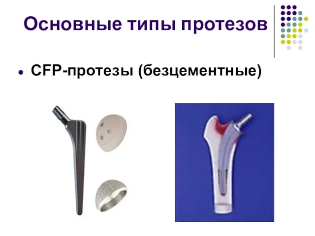 Основные типы протезов CFP-протезы (безцементные)