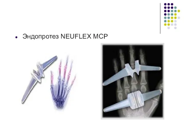 Эндопротез NEUFLEX MCP