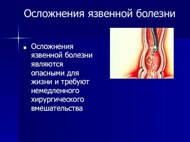 Осложнения язвенной болезни Осложнения язвенной болезни являются опасными для жизни и требуют немедленного хирургического вмешательства