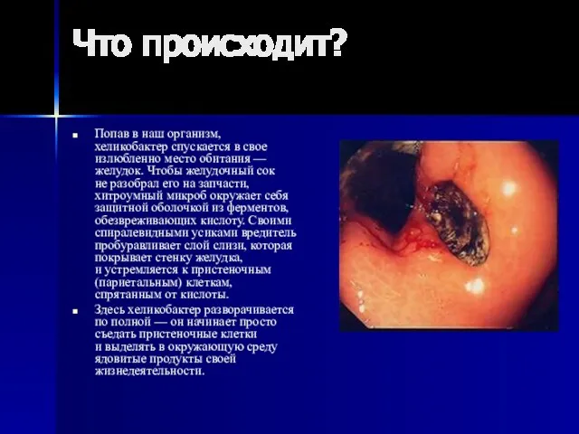 Что происходит? Попав в наш организм, хеликобактер спускается в свое