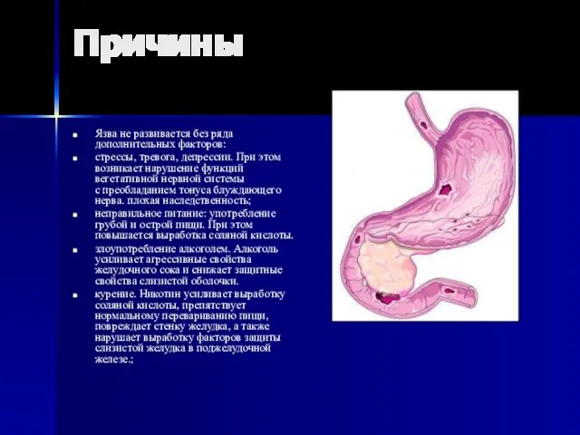 Причины Язва не развивается без ряда дополнительных факторов: стрессы, тревога,