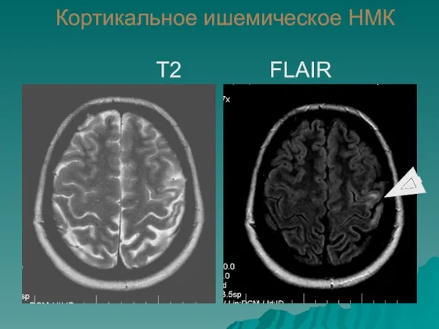 Кортикальное ишемическое НМК Т2 FLAIR