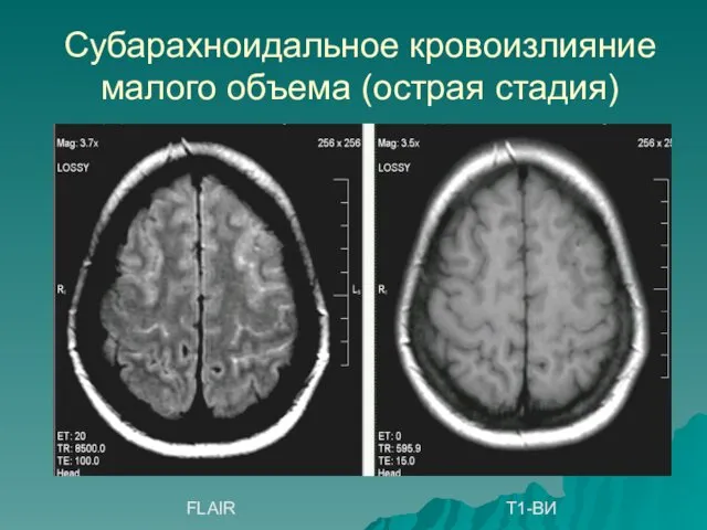 Субарахноидальное кровоизлияние малого объема (острая стадия) FLAIR Т1-ВИ