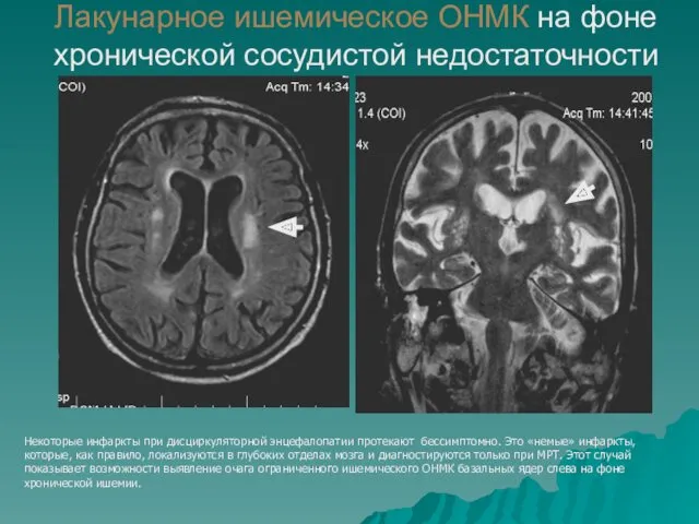 Лакунарное ишемическое ОНМК на фоне хронической сосудистой недостаточности Некоторые инфаркты