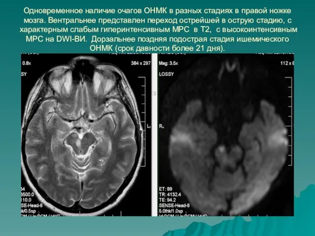 Одновременное наличие очагов ОНМК в разных стадиях в правой ножке