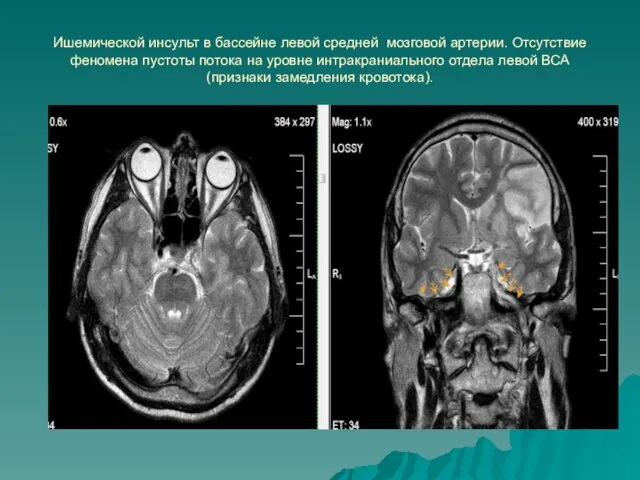 Ишемической инсульт в бассейне левой средней мозговой артерии. Отсутствие феномена