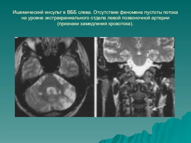 Ишемический инсульт в ВББ слева. Отсутствие феномена пустоты потока на