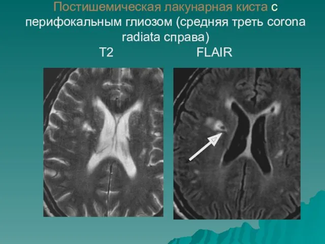 Постишемическая лакунарная киста с перифокальным глиозом (средняя треть corona radiata справа) Т2 FLAIR