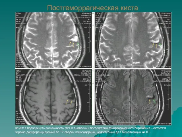 Постгеморрагическая киста Хочется подчеркнуть возможность МРТ в выявлении последствий геморрагического