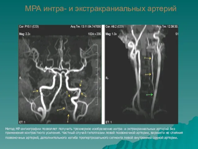 МРА интра- и экстракраниальных артерий Метод МР-ангиографии позволяет получить трехмерное