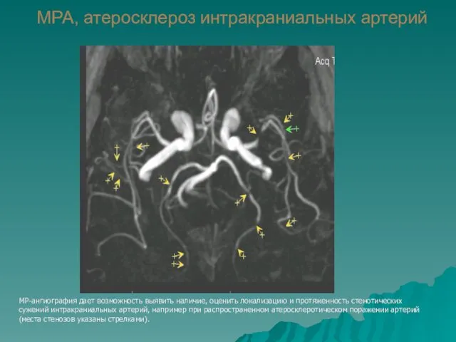 МРА, атеросклероз интракраниальных артерий МР-ангиография дает возможность выявить наличие, оценить